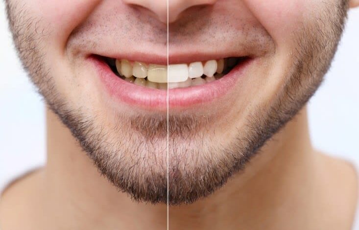 أسنان ناصعة البياض